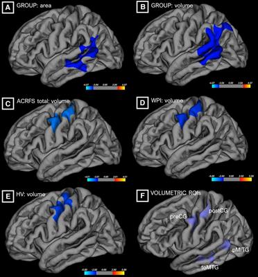 Topology of pain networks in patients with temporomandibular disorder and pain-free controls with and without concurrent experimental pain: A pilot study